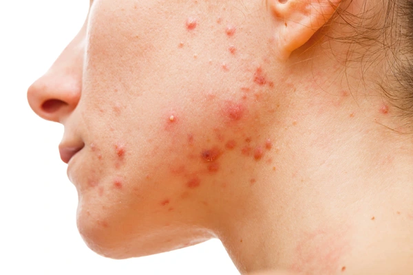 Twarz z wyraźnymi niedoskonałościami